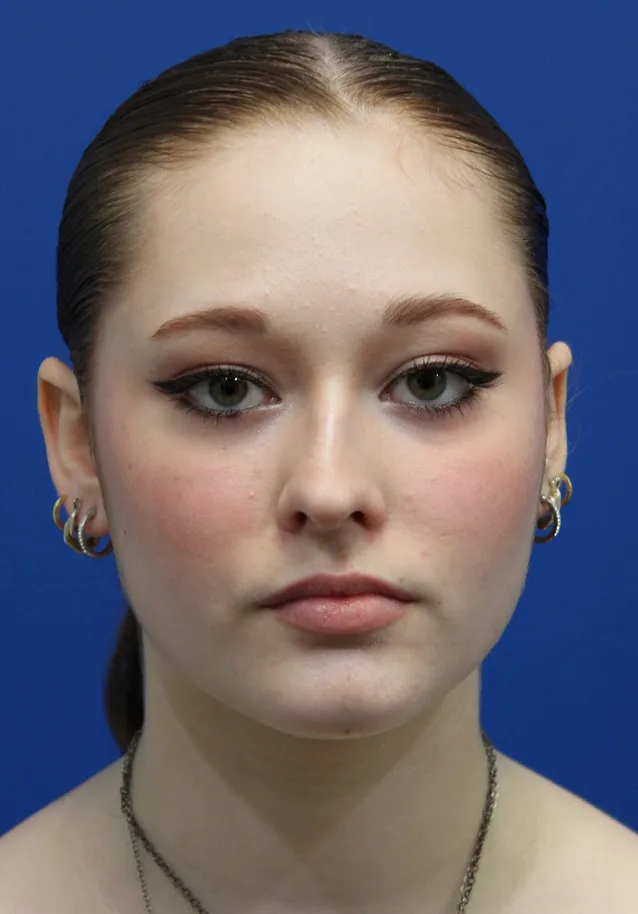 Rhinoplasty Before & After Patient #5286