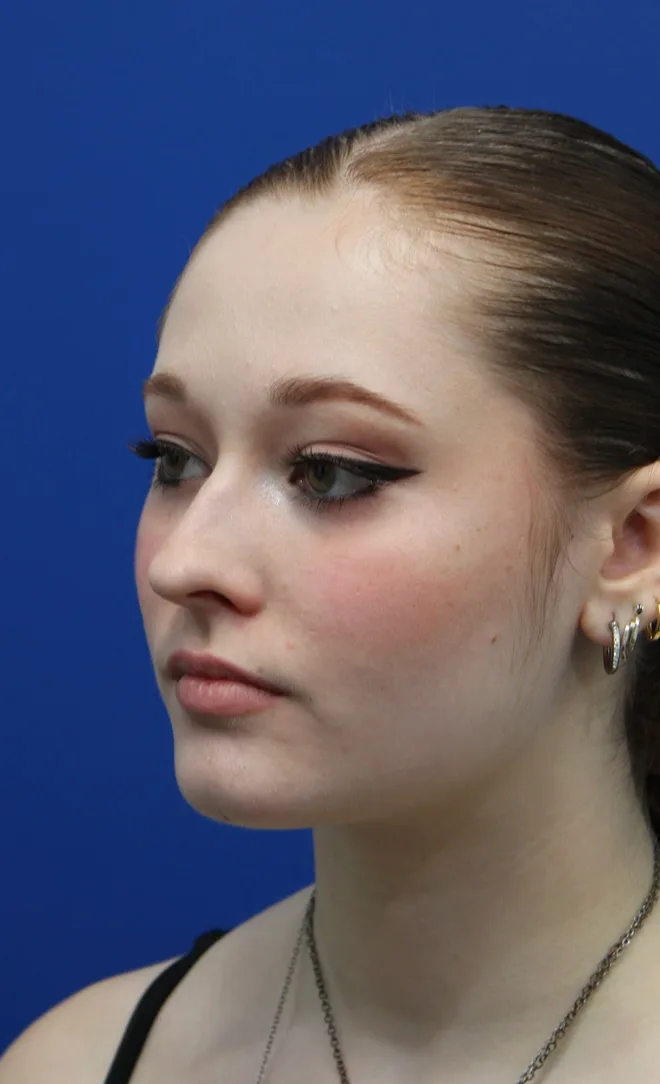 Rhinoplasty Before & After Patient #5286