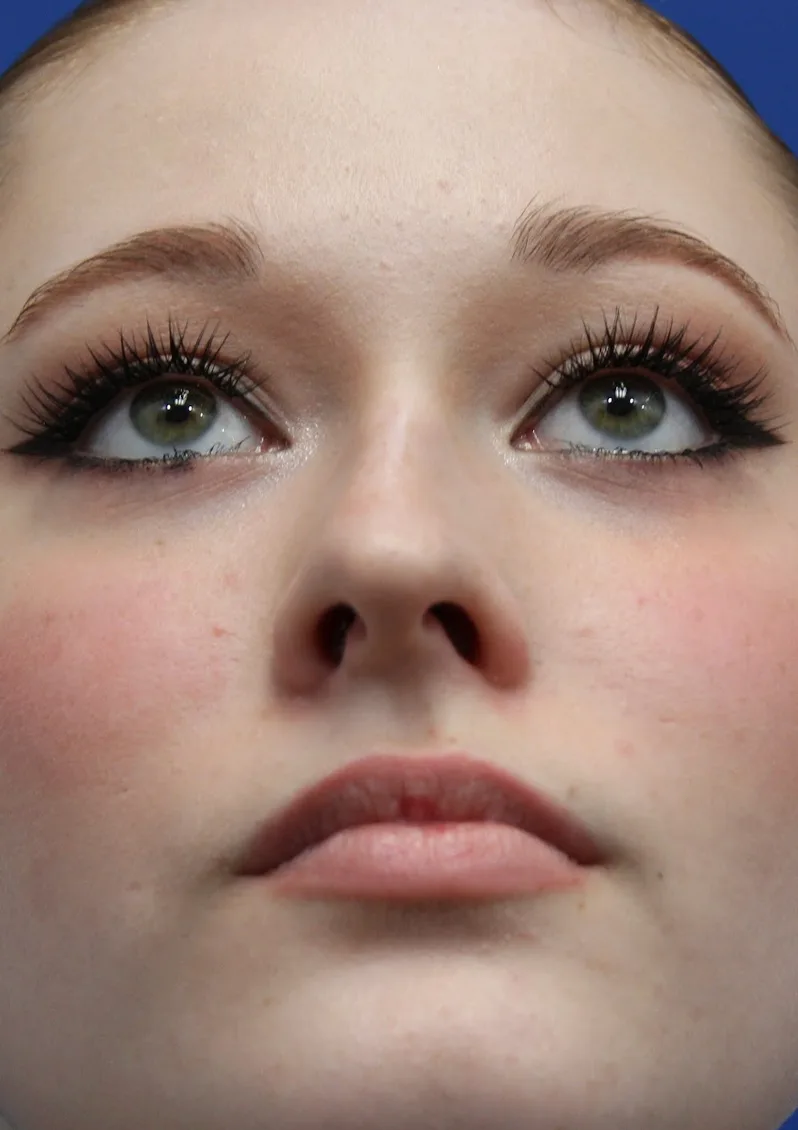 Rhinoplasty Before & After Patient #5286