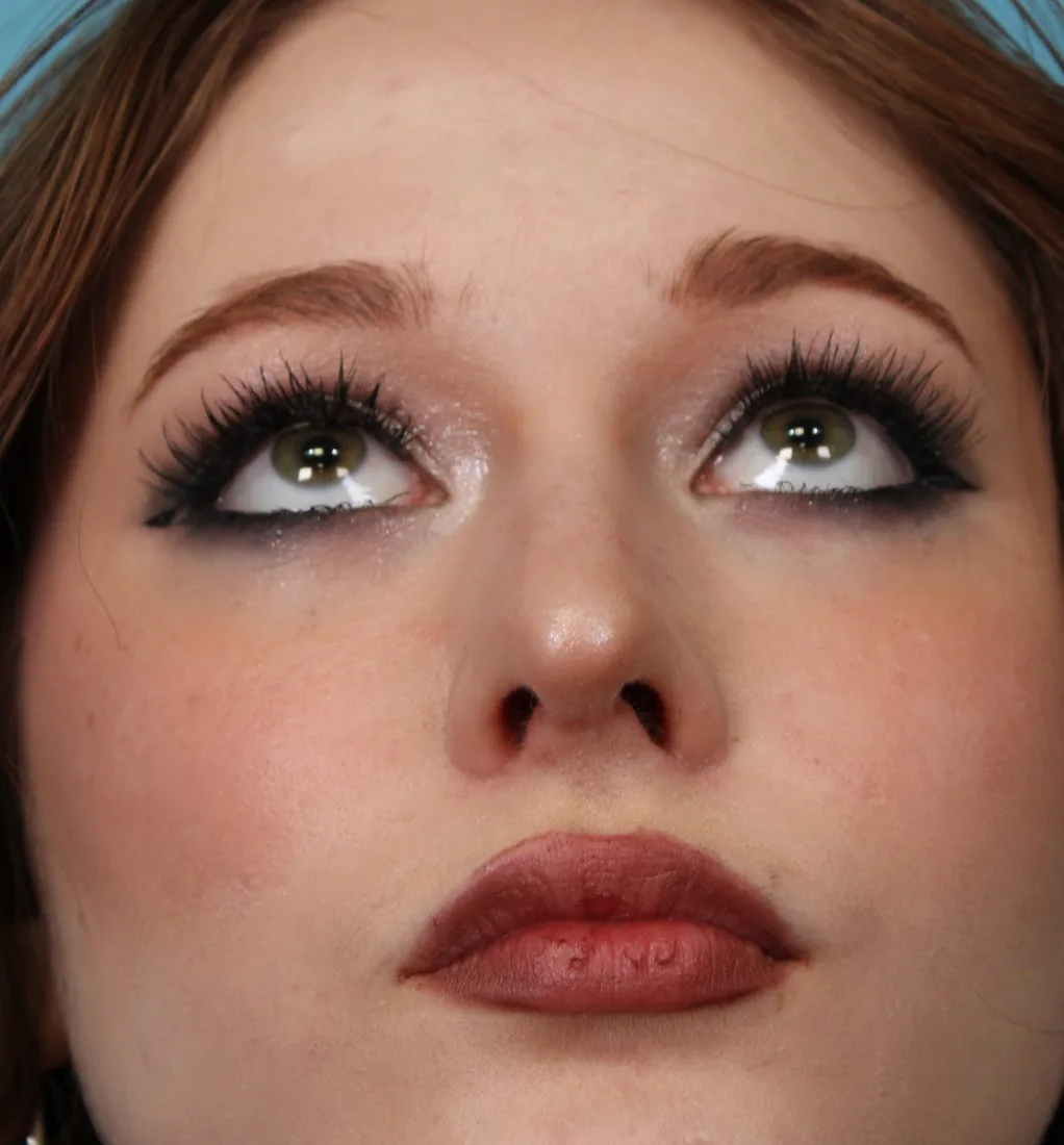 Rhinoplasty Before & After Patient #5286