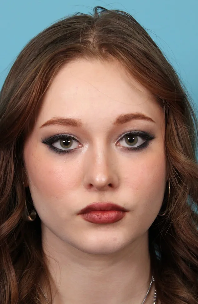 Rhinoplasty Before & After Patient #5286