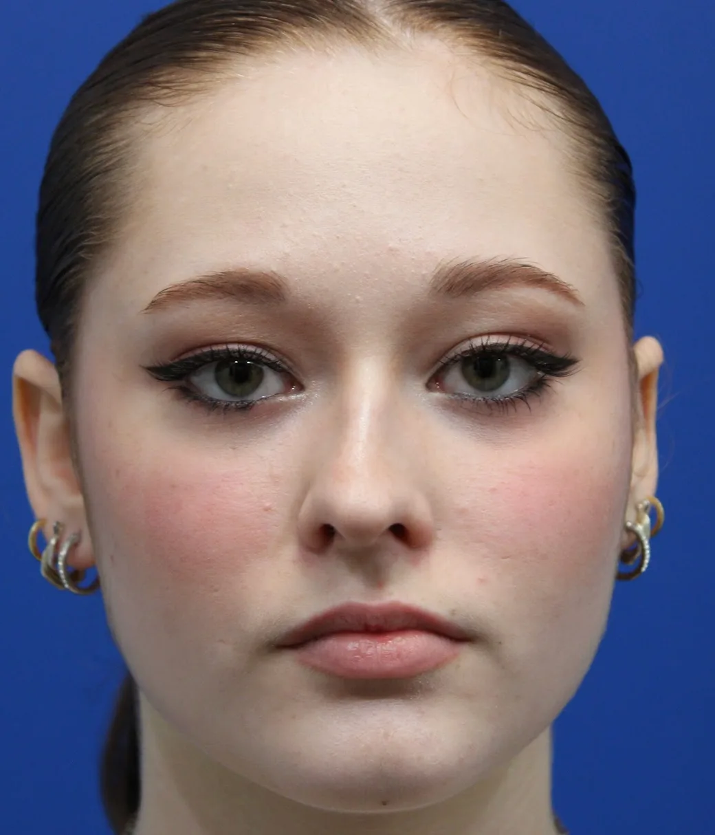 Rhinoplasty Before & After Patient #5286