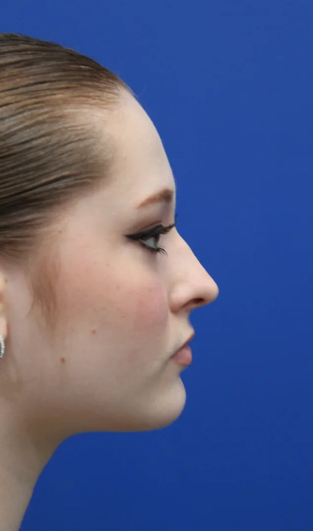 Rhinoplasty Before & After Patient #5286