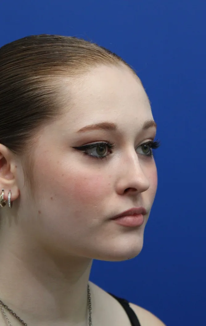 Rhinoplasty Before & After Patient #5286