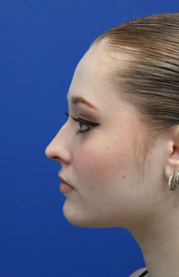 Rhinoplasty Before & After Patient #5286