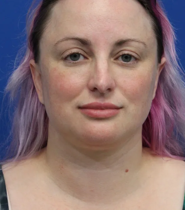 Submental Liposuction Before & After Patient #5284
