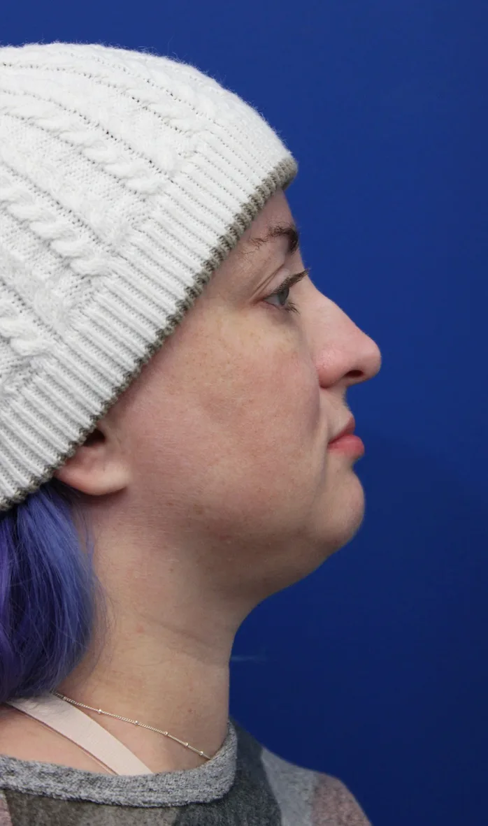 Submental Liposuction Before & After Patient #5284
