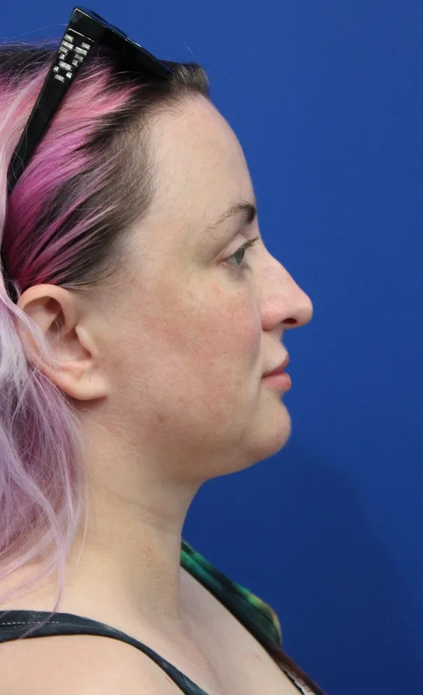 Submental Liposuction Before & After Patient #5284