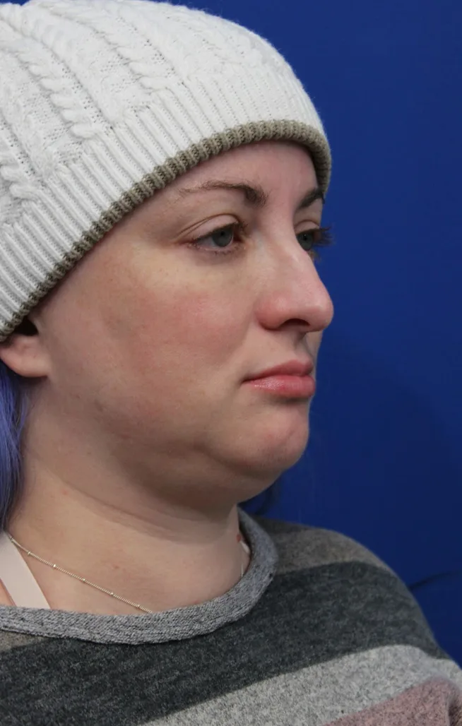 Submental Liposuction Before & After Patient #5284