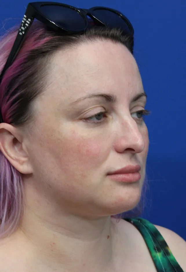 Submental Liposuction Before & After Patient #5284