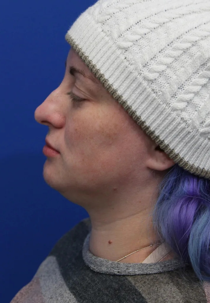 Submental Liposuction Before & After Patient #5284