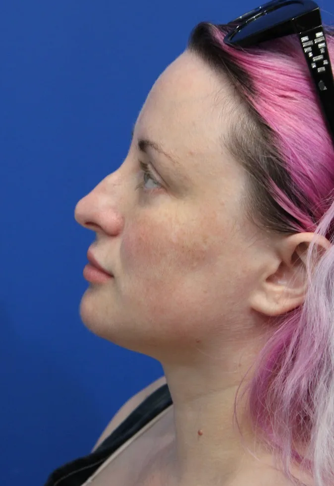 Submental Liposuction Before & After Patient #5284