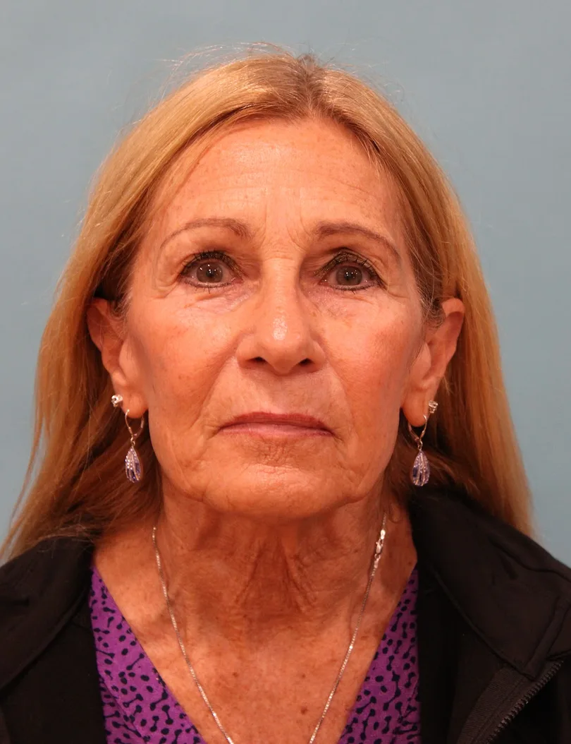 Upper Blepharoplasty Before & After Patient #5283