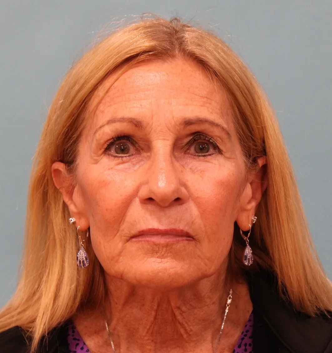 Upper Blepharoplasty Before & After Patient #5283