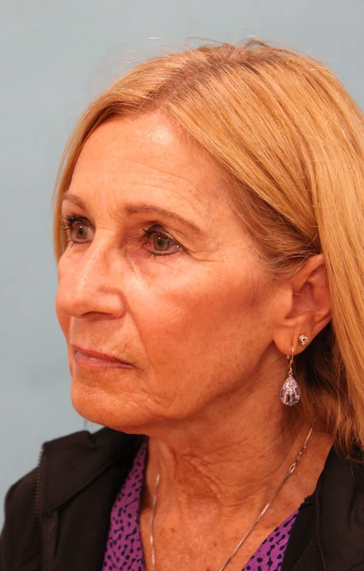 Upper Blepharoplasty Before & After Patient #5283