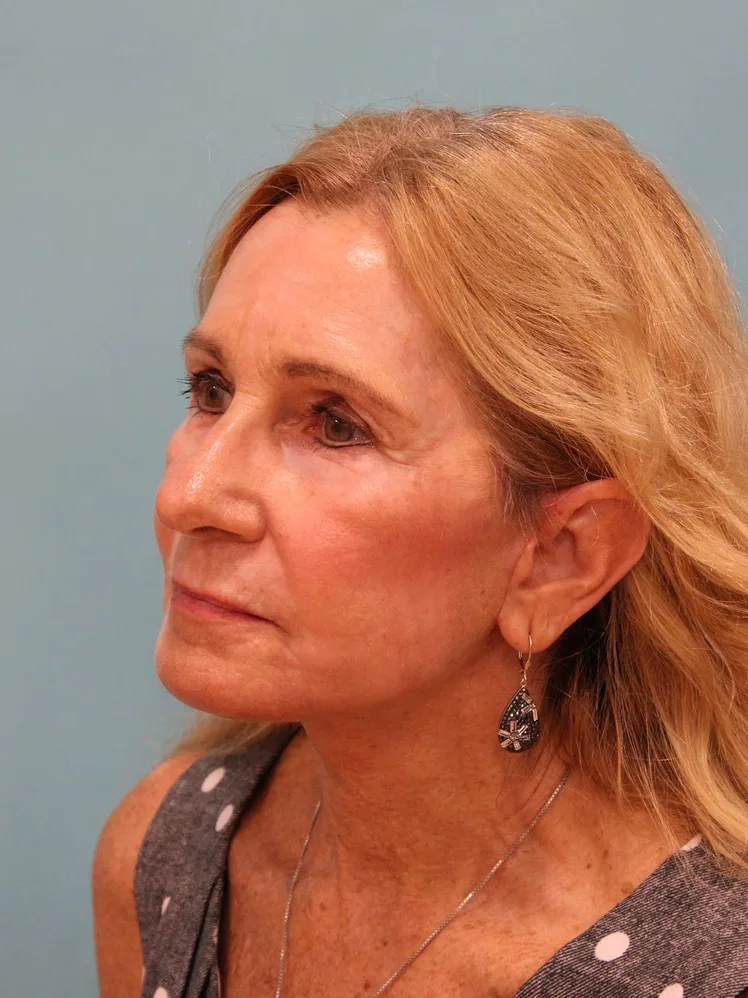 Upper Blepharoplasty Before & After Patient #5283
