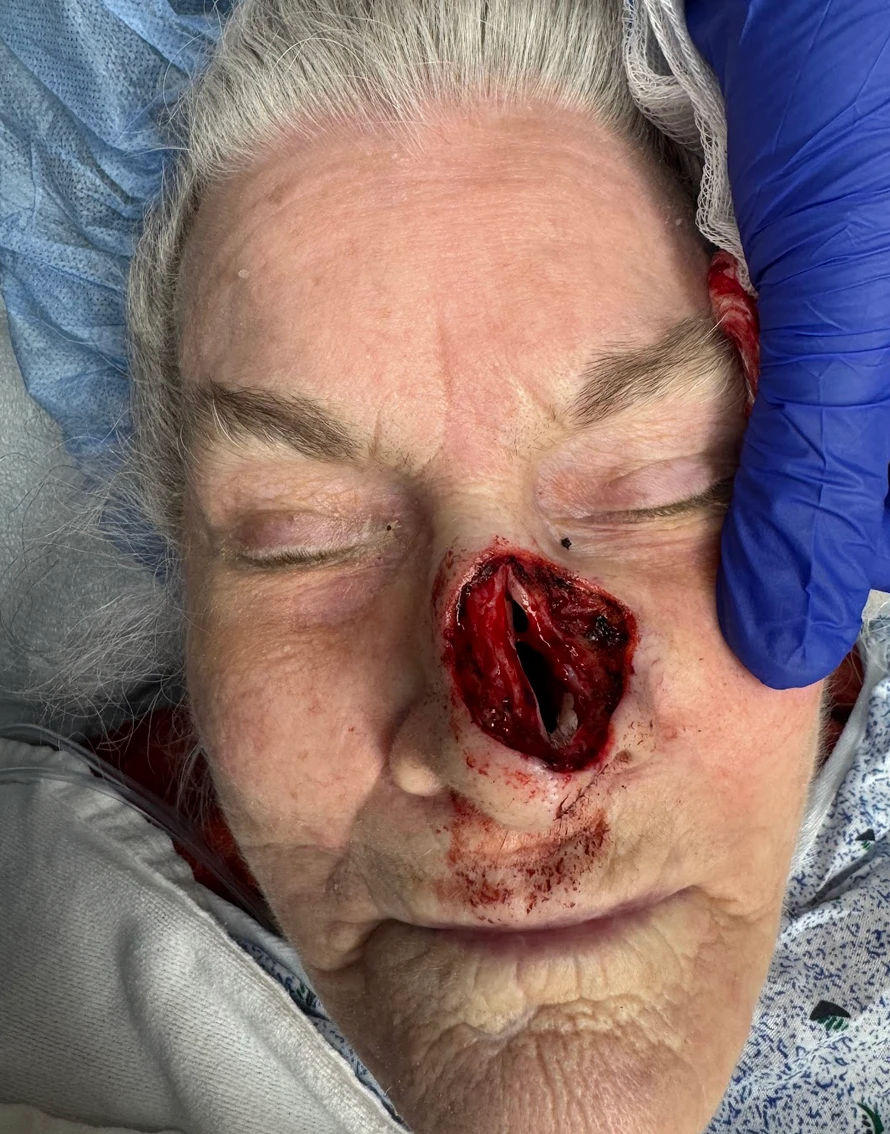 Additional treatment photograph for Mohs reconstruction case 5055, view 1