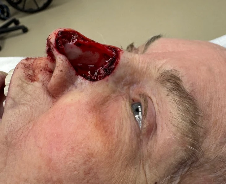 Additional treatment photograph for Mohs reconstruction case 5055, view 2