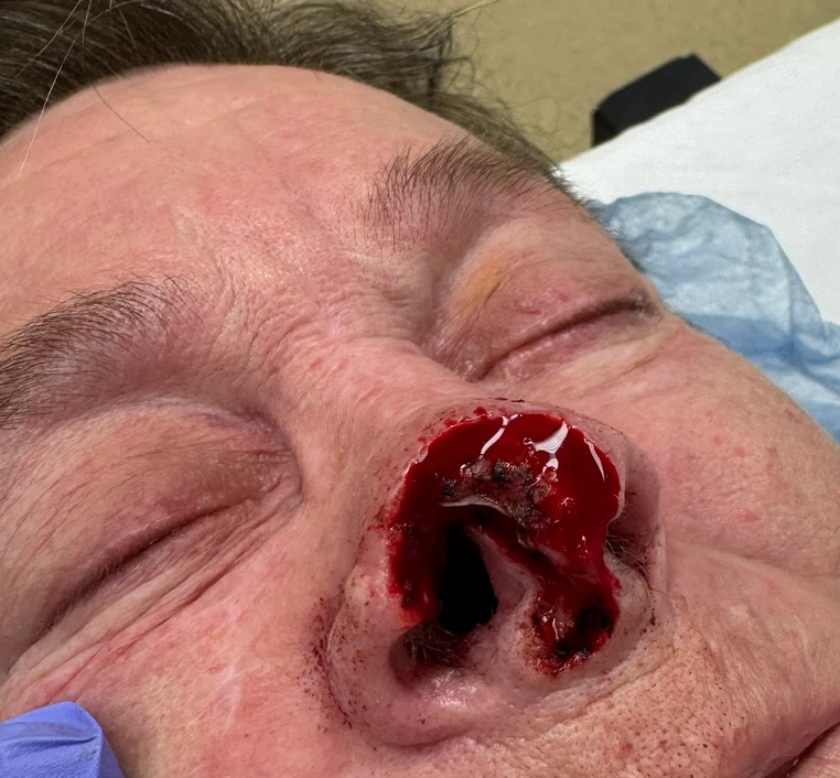 Additional treatment photograph for Mohs reconstruction case 5069, view 1