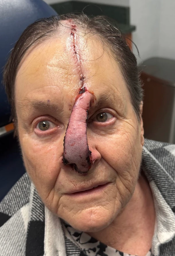 Additional treatment photograph for Mohs reconstruction case 5069, view 2