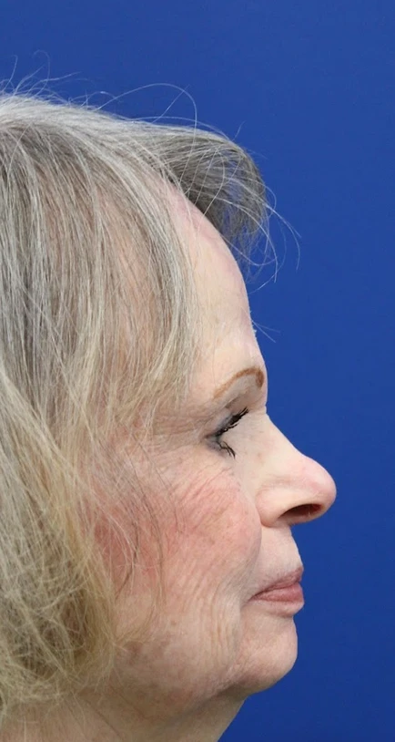 After Mohs reconstruction, side view