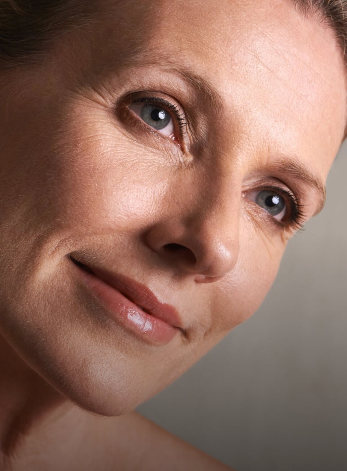Blepharoplasty