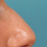 Rhinoplasty Before & After Patient #4665