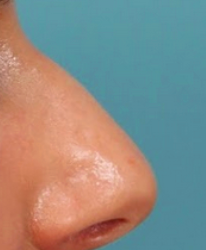 Rhinoplasty Before & After Patient #4665