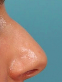 Rhinoplasty Before & After Patient #4665
