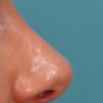 Rhinoplasty Before & After Patient #4665