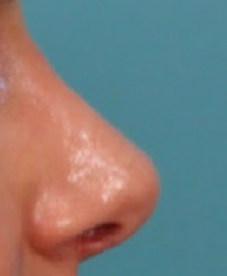 Rhinoplasty Before & After Patient #4665