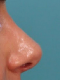 Rhinoplasty Before & After Patient #4665