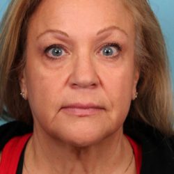 Facelift Before & After Patient #4655