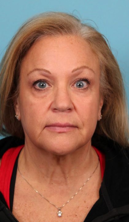 Facelift Before & After Patient #4655