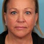 Facelift Before & After Patient #4655