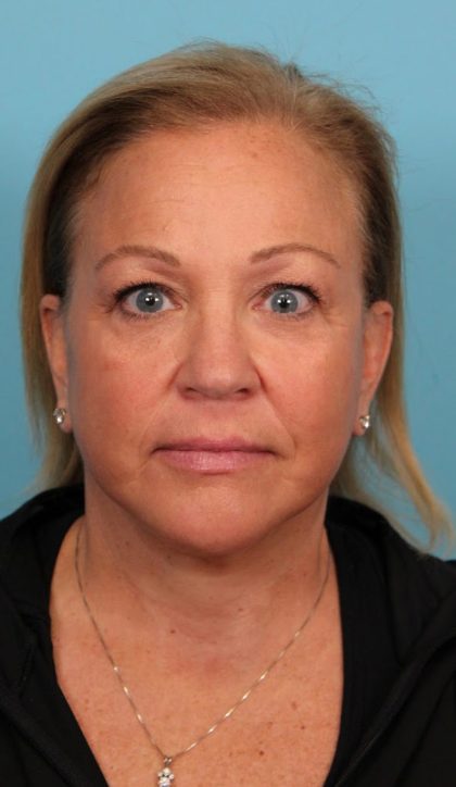 Facelift Before & After Patient #4655