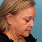 Facelift Before & After Patient #4655