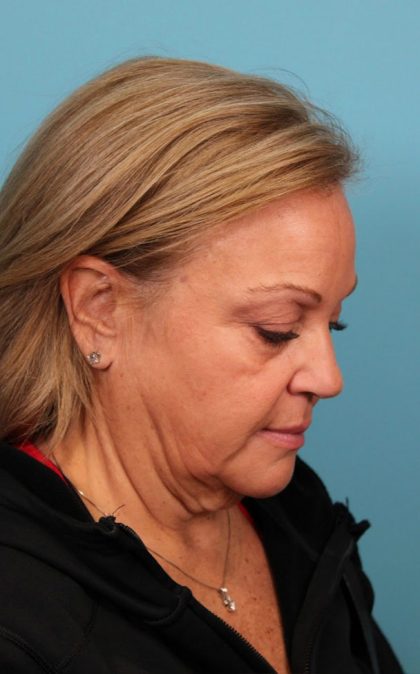 Facelift Before & After Patient #4655