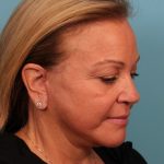 Facelift Before & After Patient #4655