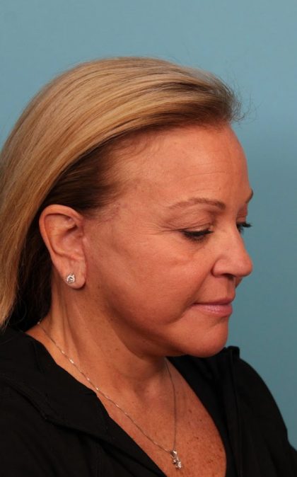Facelift Before & After Patient #4655