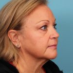 Facelift Before & After Patient #4655