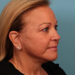 Facelift Before & After Patient #4655