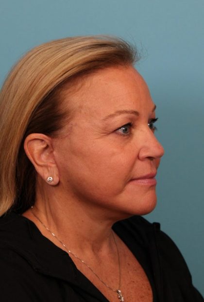 Facelift Before & After Patient #4655