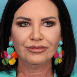 Facelift Before & After Patient #4656