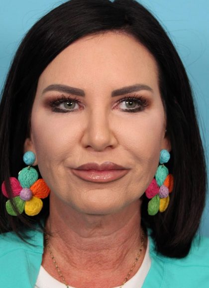 Facelift Before & After Patient #4656