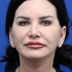 Facelift Before & After Patient #4656