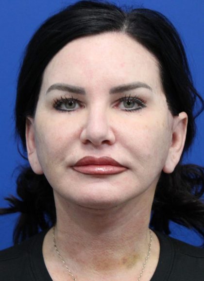 Facelift Before & After Patient #4656