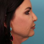 Facelift Before & After Patient #4656