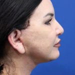 Facelift Before & After Patient #4656