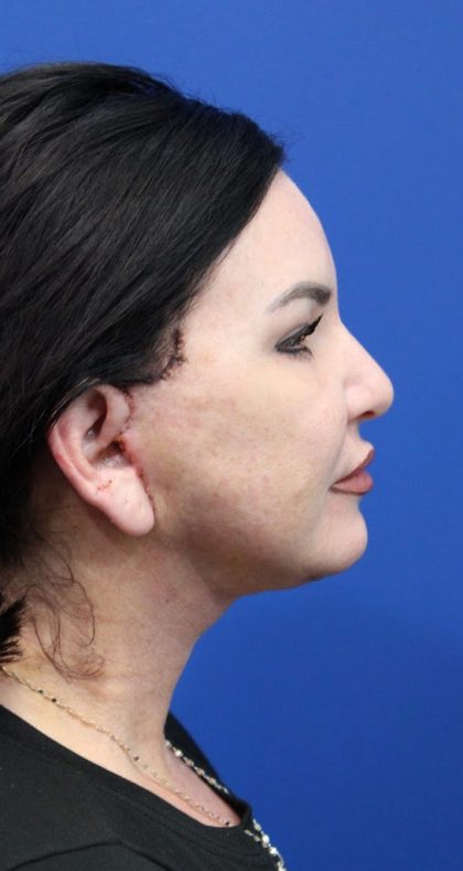 Facelift Before & After Patient #4656